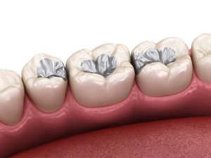 Amalgam,Restoration.,Medically,Accurate,3d,Animation,Of,Dental,Concept