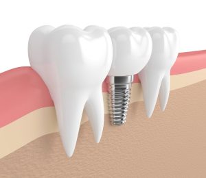 dental-Implant-1024x888